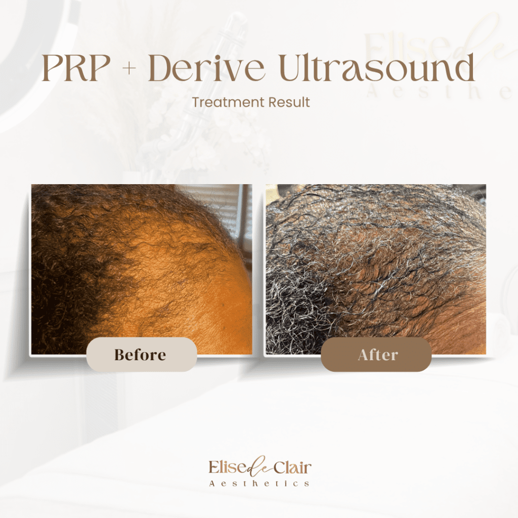 PRP + Derive Ultrasound (2)