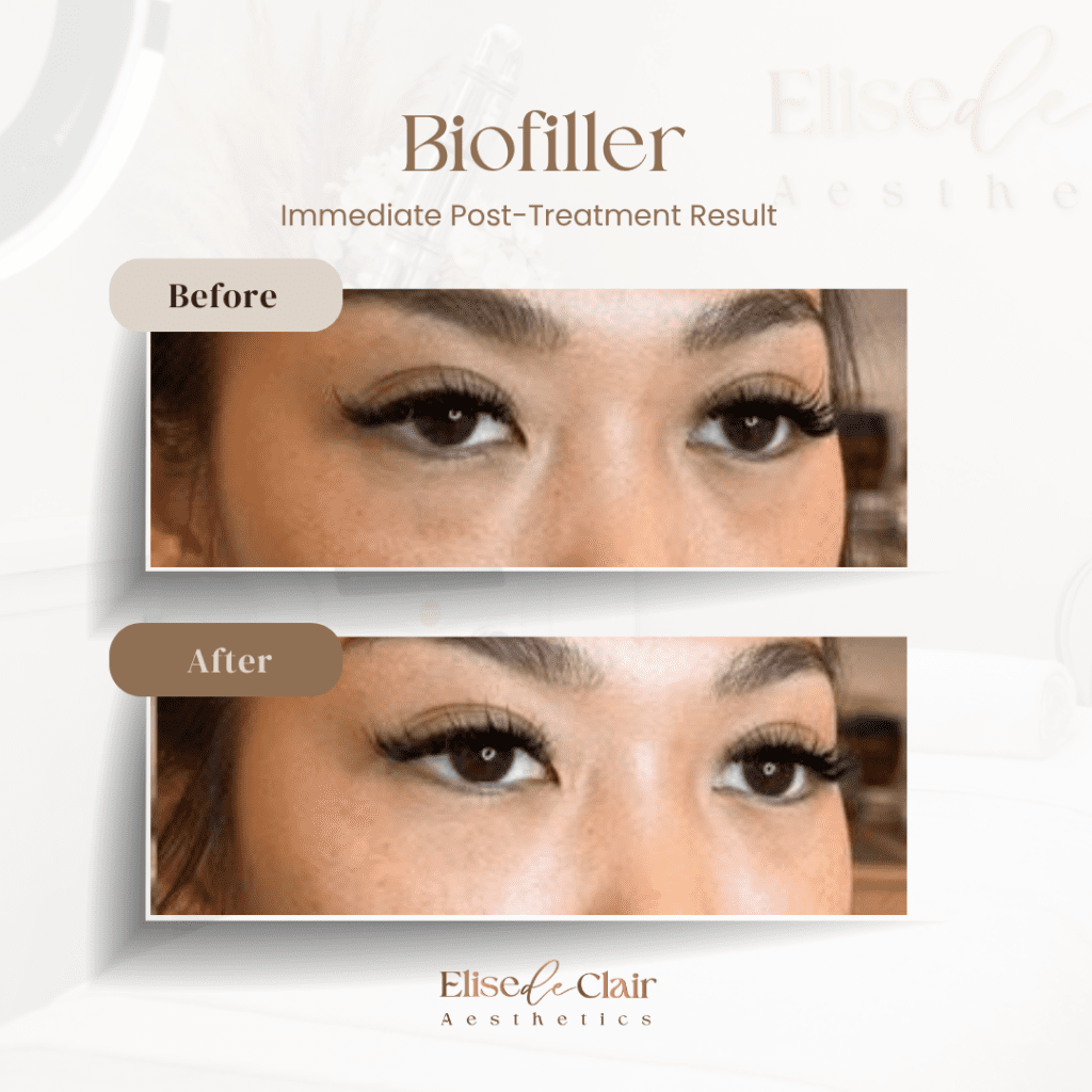 BioFiller