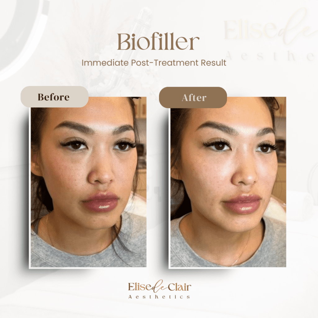 BioFiller (2)