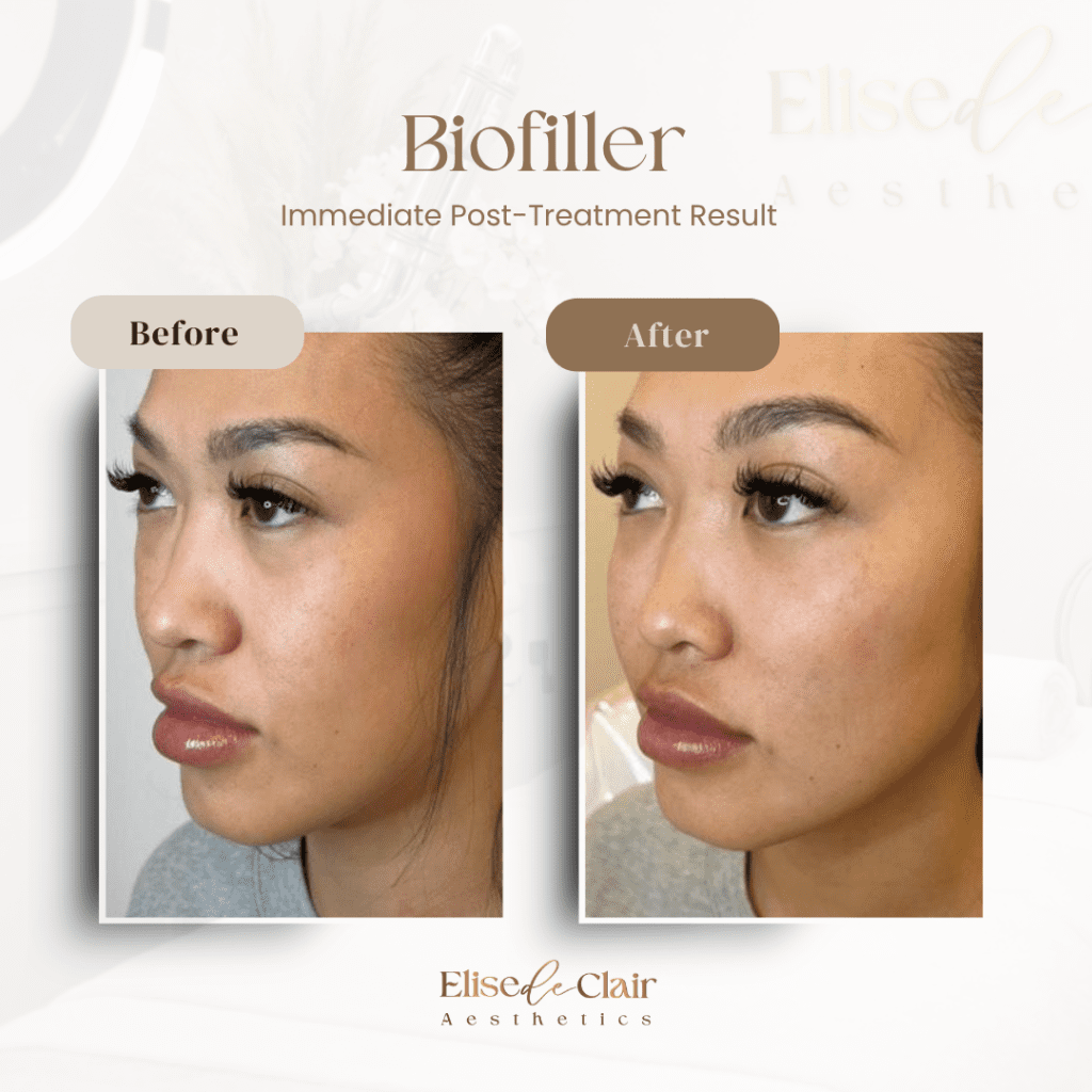 BioFiller (3)