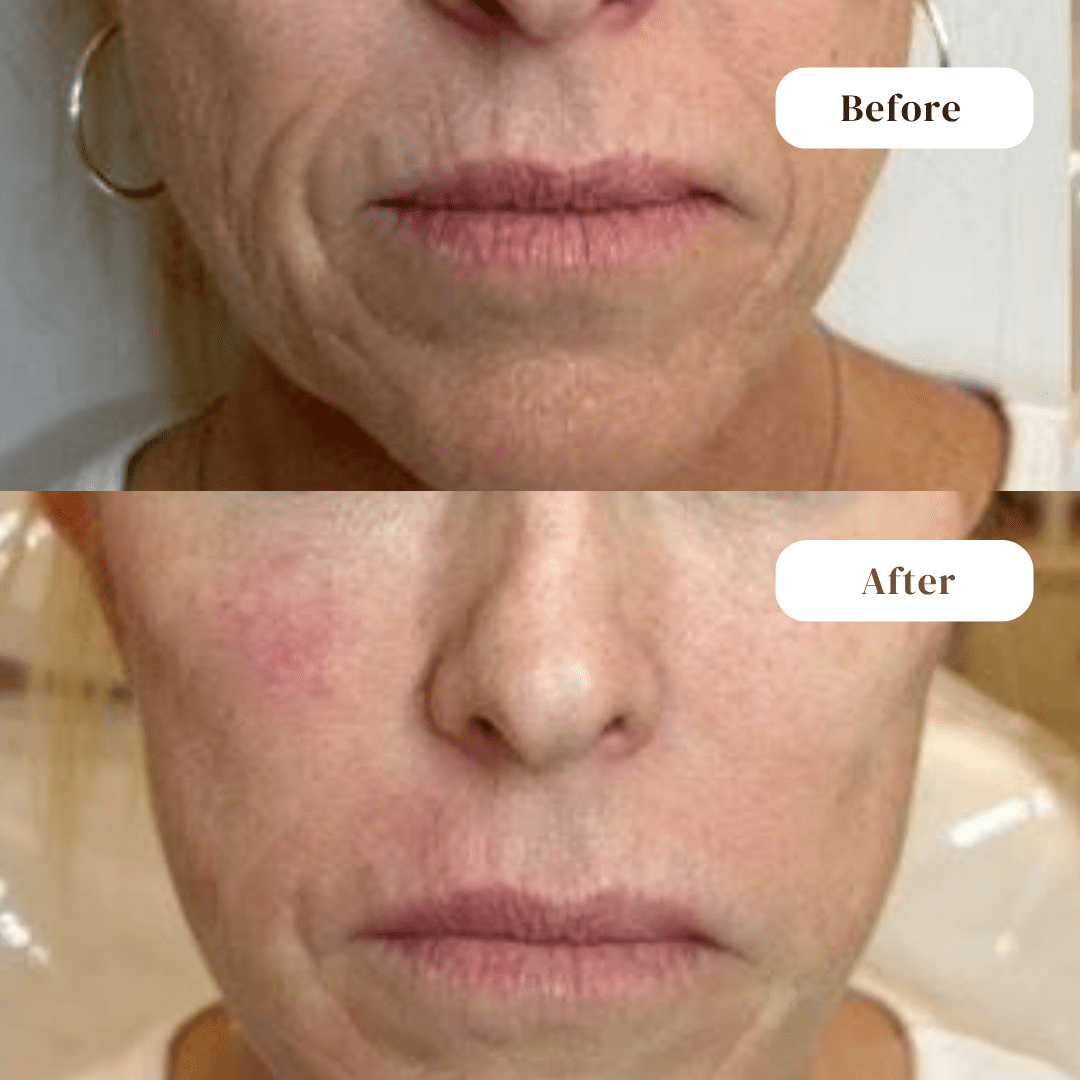 Dermal Filler - before and after