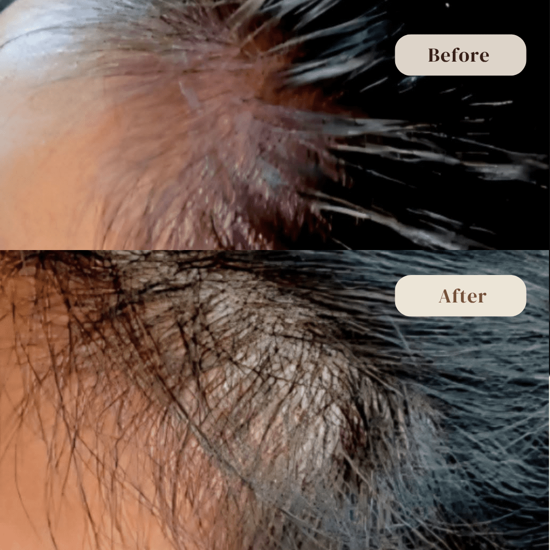 hair restoration before and after