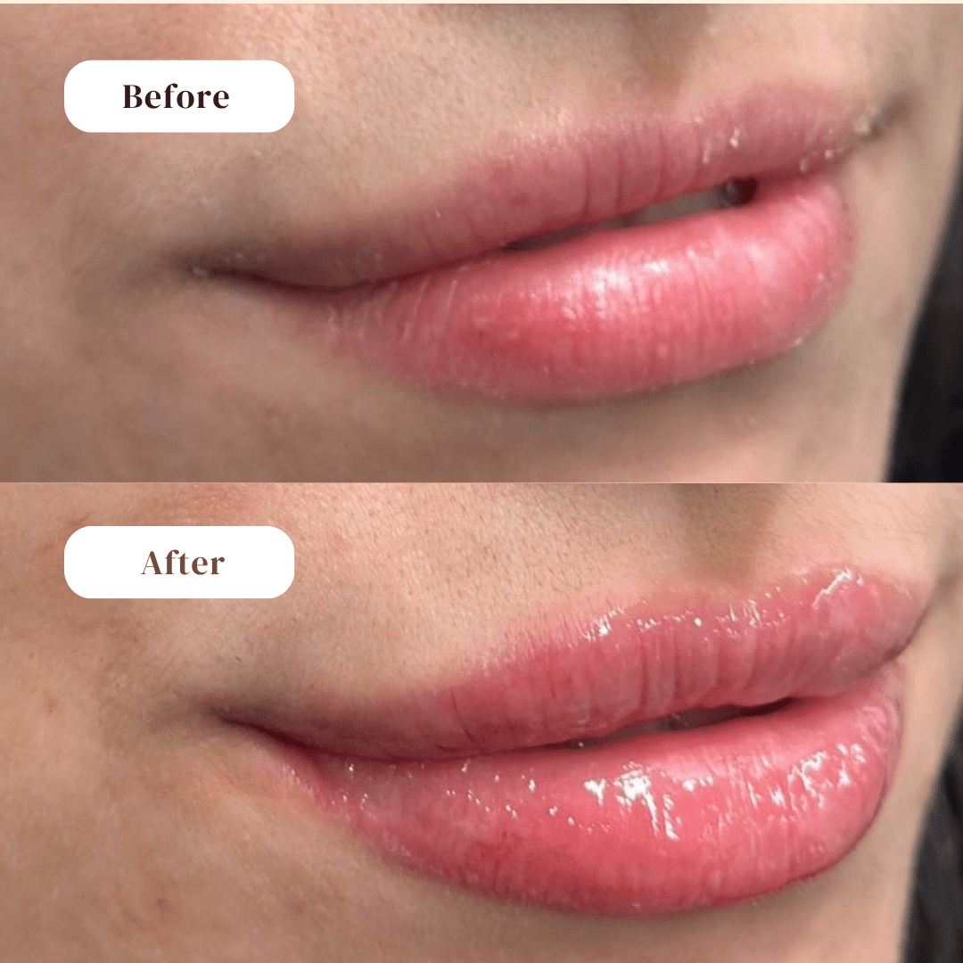 lip Filler - before and after