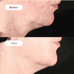 XERF BEFORE AND AFTER TREATMENT RESULT 1