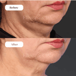 XERF BEFORE AND AFTER TREATMENT RESULT
