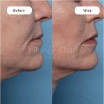 XERF BEFORE AND AFTER TREATMENT RESULT 2