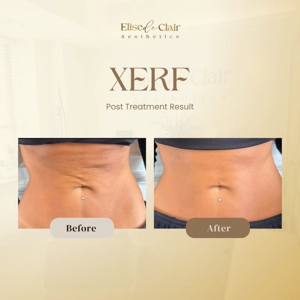 XERF BEFORE AND AFTER