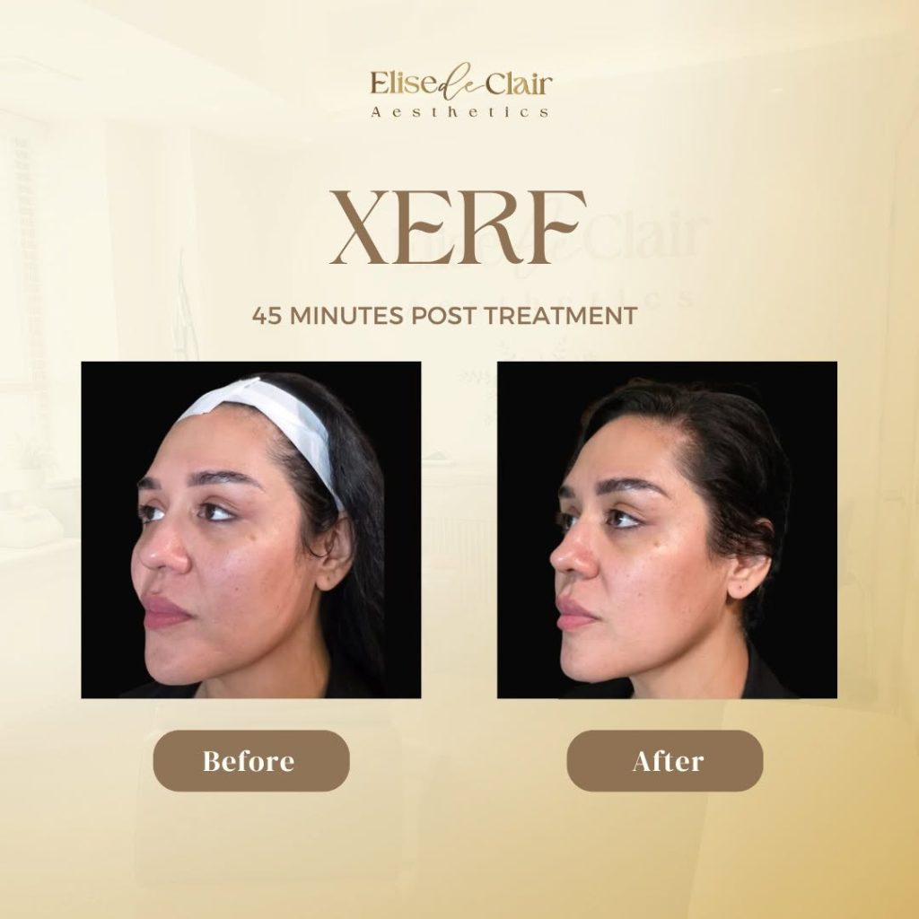 XERF BEFORE AND AFTER 45 MINS