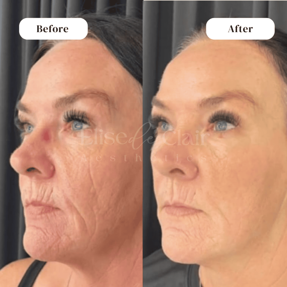 NOUVADERM BEFORE AND AFTER TREATMENT RESULT