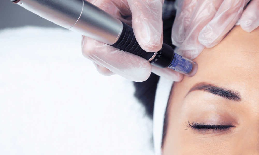 Post-Laser & Microneedling Recovery in Orland Park
