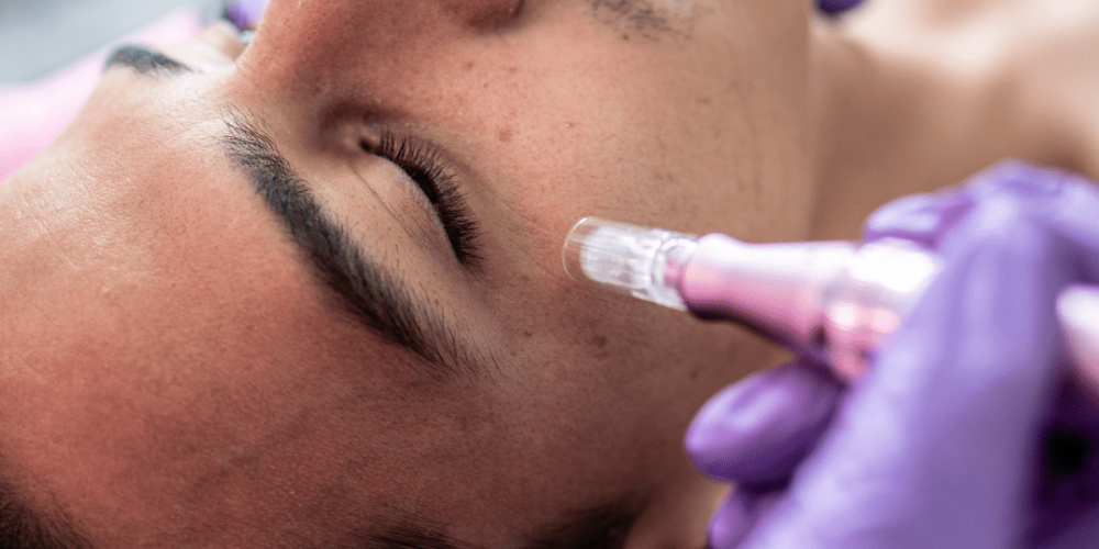 microneedling (1)
